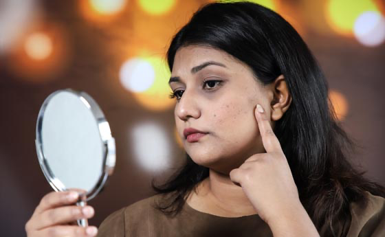 মেছতা হওয়ার কারণ যেভাবে দূর করবেন