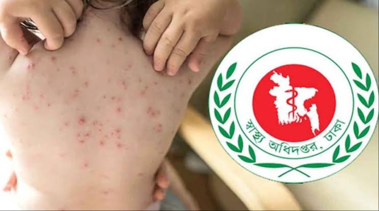 আক্রান্তের সংখ্যা বাড়ছে  হাম ও উপসর্গে ২৪ ঘণ্টায় আরও ১০ শিশুর মৃত্যু
